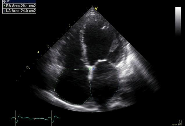 Biatrial