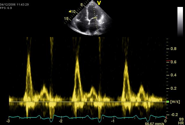 Mitralflow E E = 0,7 m/s A = 0,2 m/s DT