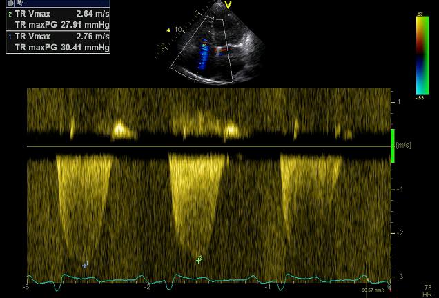 HA trykk > 20 mmhg Trp 30 mmhg Insp.