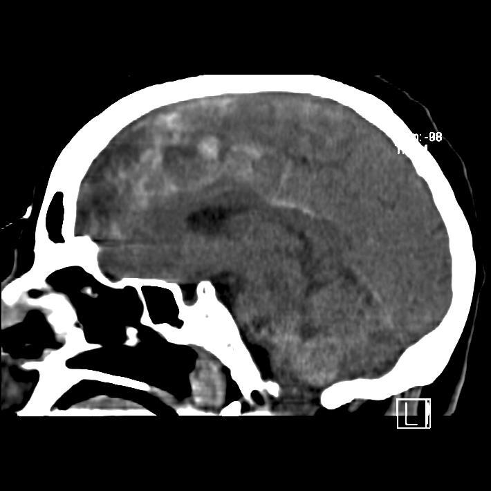 Lekkasje av CSF, skallefrakturer nevrokirurgisk vurdering Alltid CT på stabil pasient Alle