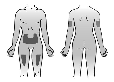 Produktet er nå klart til injeksjon. Gå UMIDDELBART til trinn 7. Trinn 7. Velge og klargjøre injeksjonsstedet Bruk: Ny alkoholserviett. Gjør som følger: Velg injeksjonssted.