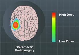 org «Total hjerne» og stereotaktisk strålebehandling
