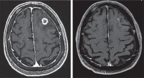 Stereotaksi før og etter behandling Nature Reviews Clinical Oncology6, 377 378 (2009) Effekter og bivirkninger av strålebehandling ved hjernemetastaser Effekter: Symptomlindring (?