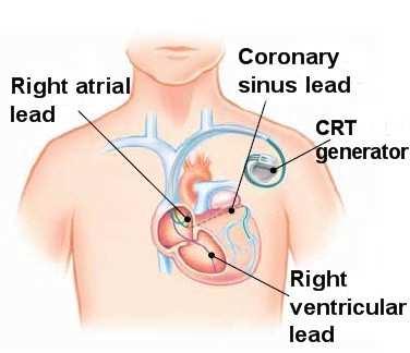 Hvorfor ICD?