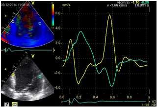 32 DAVID EF 26% (VVI - paces ikke) og 28% (DDD - paces) Hvordan uskadeliggjøre RV pacing? Unngå apikal pacing plassere ledningen alternativt RVOT / septum / HIS nært.