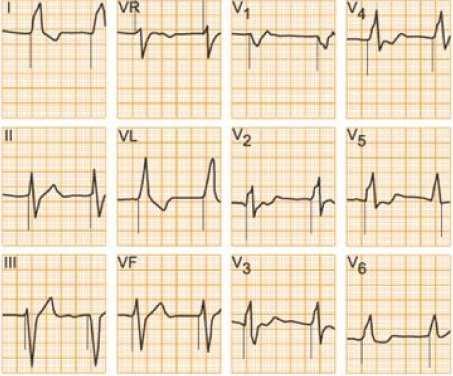 LV pacing / Biventrikulær pacing From: Dual-Chamber Pacing or Ventricular Backup Pacing in Patients With an Implantable Defibrillator: The Dual Chamber and VVI Implantable Defibrillator (DAVID) Trial