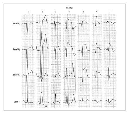 ST-elevasjon under sykdom VVH LBBB aper Hkal STEMI