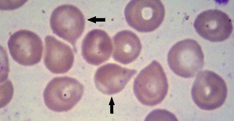 Dakriociti su eritrociti u obliku suze i nastaju zbog nemogućnosti membrane