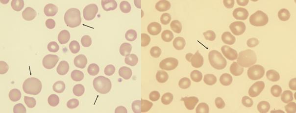Pojava promene boje eritrocita je anizohromija, koja je i pokazatelj promene koncentracije Hb u njima. Poznato ja da se u eritrocitima nalazi Hb koji prenosi kiseonik.