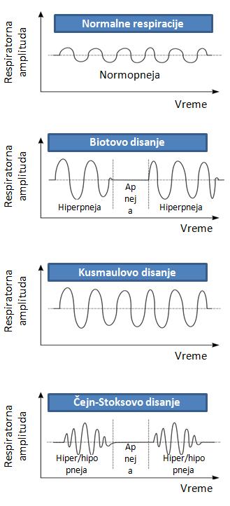 potpuno nepravilan ritam i dubina disanja s nepravilnim smenjivanjem perioda apneje i dubljih ili plićih respiracija.