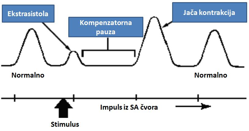 Heterotopni poremećaji stvaranja impulsa u srcu Heterotopni poremećaji nastaju kada izvan SA ĉvora nastaju razdraţenja koja dovode do kontrakcije srca ili nekih njegovih delova tokom redovnog srĉanog