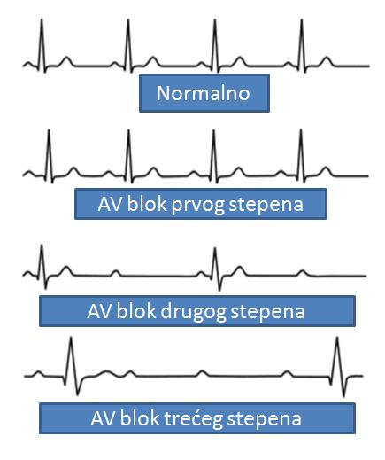 Slika 98. EKG nalaz kod AV bloka Poremećaji funkcije miokarda Miokard ima glavnu funkciju u procesu pumpanja krvi i obezbeċivanja cirkulacije.