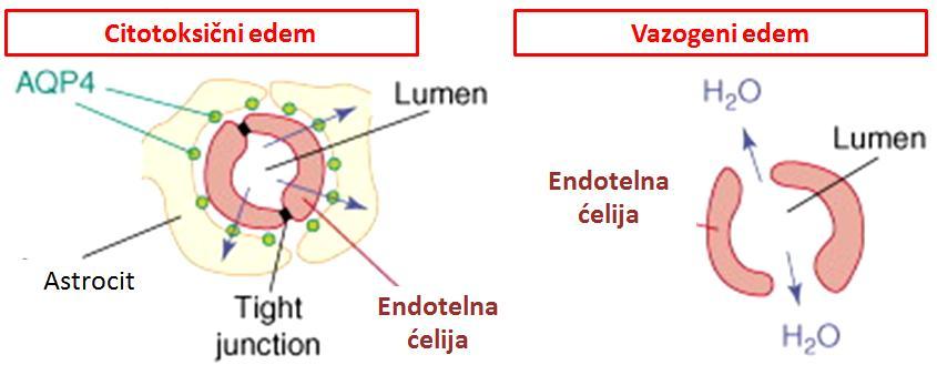 Slika 132. Kretanje vode kod citotoksiĉnog i vazogenog edema Kao posledica povećanja zapremine moţdanog tkiva moţe doći do povećanja intrakranijalnog pritiska.