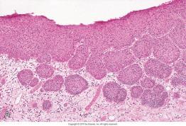 mindre, basaloide celler Tydelige intercellulærbroer; tydelig