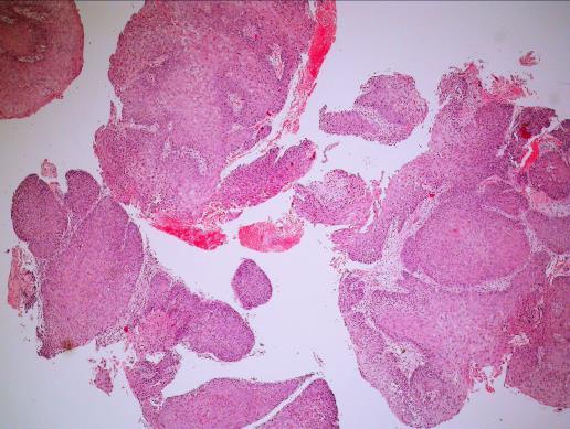 + Høyt differensiert PEK: MORFOLOGI Verrukøs PEK: ikke cellulær atypi Papillært PEK: viser papiller og typisk keratinisering Pseudoepiteliomatøs plateepitelhyperplasi: ingen atypi, ingen atypiske