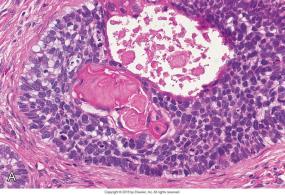 H: sinus piriformis Makro: ikke karakteristisk Prognose: høyer risiko for lymfeknute-, og fjernmetastaser enn vanlig