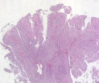 4 Papillært plateepitelkarsinom Def og mikro: papillært vekstmønster med tynne fibrovasculære stromastilker kledd av