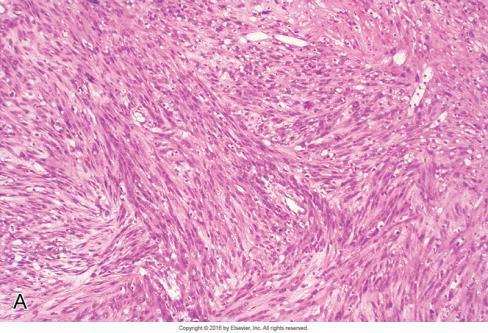 A.5 Spolcellet plateepitelkarsinom mikro Utgår fra overflateepitelet og viser en divergent epitelial-mesenkymal differensiering Oftest eksofytisk vekstmønster med ulcerasjon Overgang fra dysplastisk