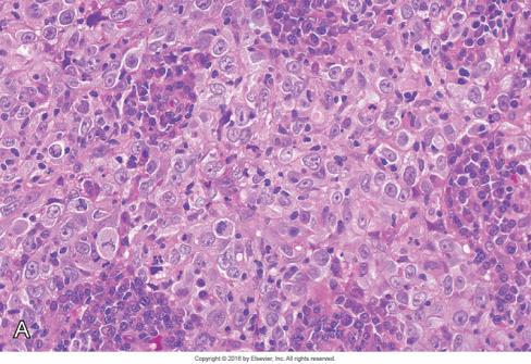 Hypofarynks og larynks 1. Anatomi og histologi 2. Ikke-neoplastiske lesjoner A. Maligne svulster fra overflateepitelet B. Prekursorlesjoner C.