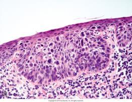 intakt basalmembran - ingen stromale forandringer Cytologiske kriterier atypi mitoser Lavgradig dysplasi minimal; parabasale cellene har -noe mer cytoplasma enn basallagscellene, -forstørrete kjerner