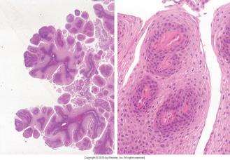 11) Epid: hyppig; Reccurent Respiratory papillomatosis; sjelden Etiologi: HPV 6 og 11; seksuell kontakt, maternal kontakt Lokalisasjon: glottisk, og spredning opp- og nedover Klinisk: heshet, stridor