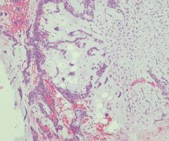 D. Spyttkjertelsvulster D. Spyttkjertelsvulster 1. Adenoid cystisk karsinom 2. Pleomorft adenom Få kasus; (ary)epiglottisk 1. Adenoid cystisk karsinom 2. Pleomorft adenom 3.