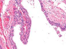 Onkocytært papillært cystadenom Hypofarynks og larynks Hypofarynks og larynks 1. Anatomi og histologi 2. Ikke-neoplastiske lesjoner A. Maligne svulster fra overflateepitelet B. Prekursorlesjoner C.