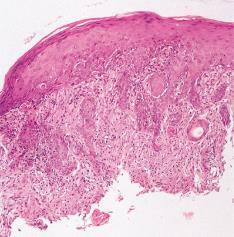 avh. av grad (0-100%); residiverer ofte Makro: submukosal, velavgrenset fettaktig tumor Mikro: Høyt differensierte: fettceller i