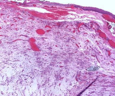 3 Inflammatorisk myofibroblastisk tumor - Mikro Submukosal proliferasjon av spolformete, stellate, epitelioide og/eller spider-like