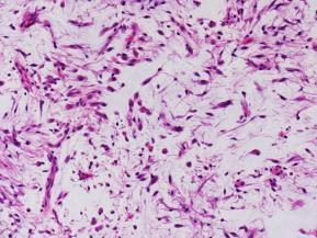 E.3 Inflammatorisk myofibroblastisk tumor - Mikro E.