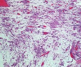 aktiner og desmin. ALK Hypofarynks og larynks 1. Anatomi og histologi 2. Ikke-neoplastiske lesjoner A. Maligne svulster fra overflateepitelet B. Prekursorlesjoner C.