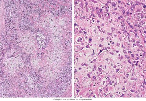 F. Brusksvulster: kondrosarkom Hypofarynks og larynks 1. Anatomi og histologi 2.