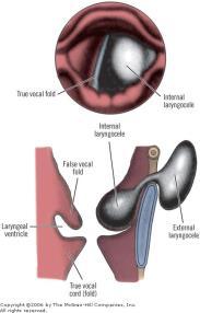 til sacculus ventriculi laryngis (sakkulær cyste: 25%) - inneholder mucin Etiologi: kongenital eller ervervet (glassblåsere, blåseinstr.