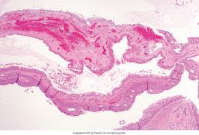 B. Laryngocyste - generell B. Laryngocele/cyste - mikro Etiologi: Kongenitalt: ofte ass. med andre cong.