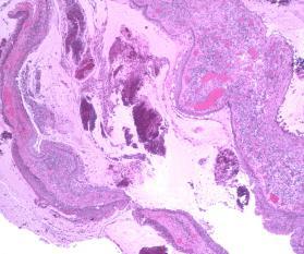 onkocytært epitel DIAGNOSE: benign epitelkledd cyste, (evt) forenlig med laryngocyste /laryngocele (relater med klinikken) C.