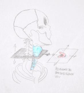 1 Klassisk plateepitelkarsinom Def: malign epitelial tumor med plateepiteldifferensiering Epid: 60-70 år; M>K