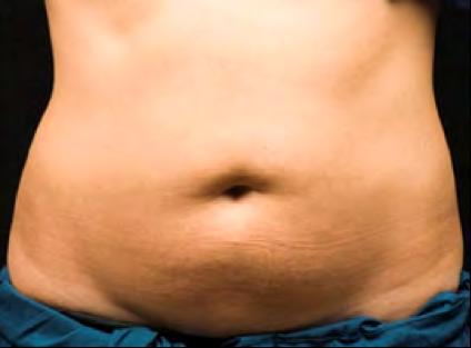 Fettfjerning uten kirurgi - Kryolipolyse 20-40% av fett fjernes permanent i
