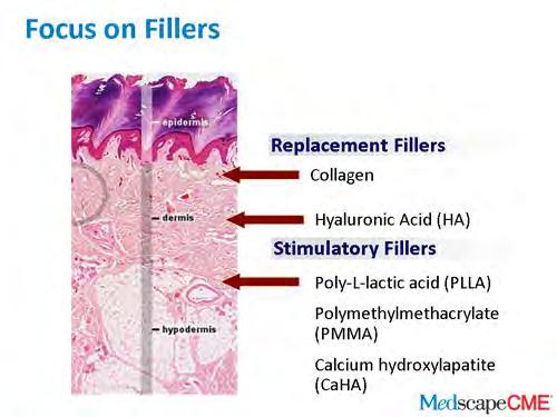 Moderne fillere Hyaluronsyre filler Poly-L-Lactic Acid/ Sculptra Calcium Hydroxylapatite/