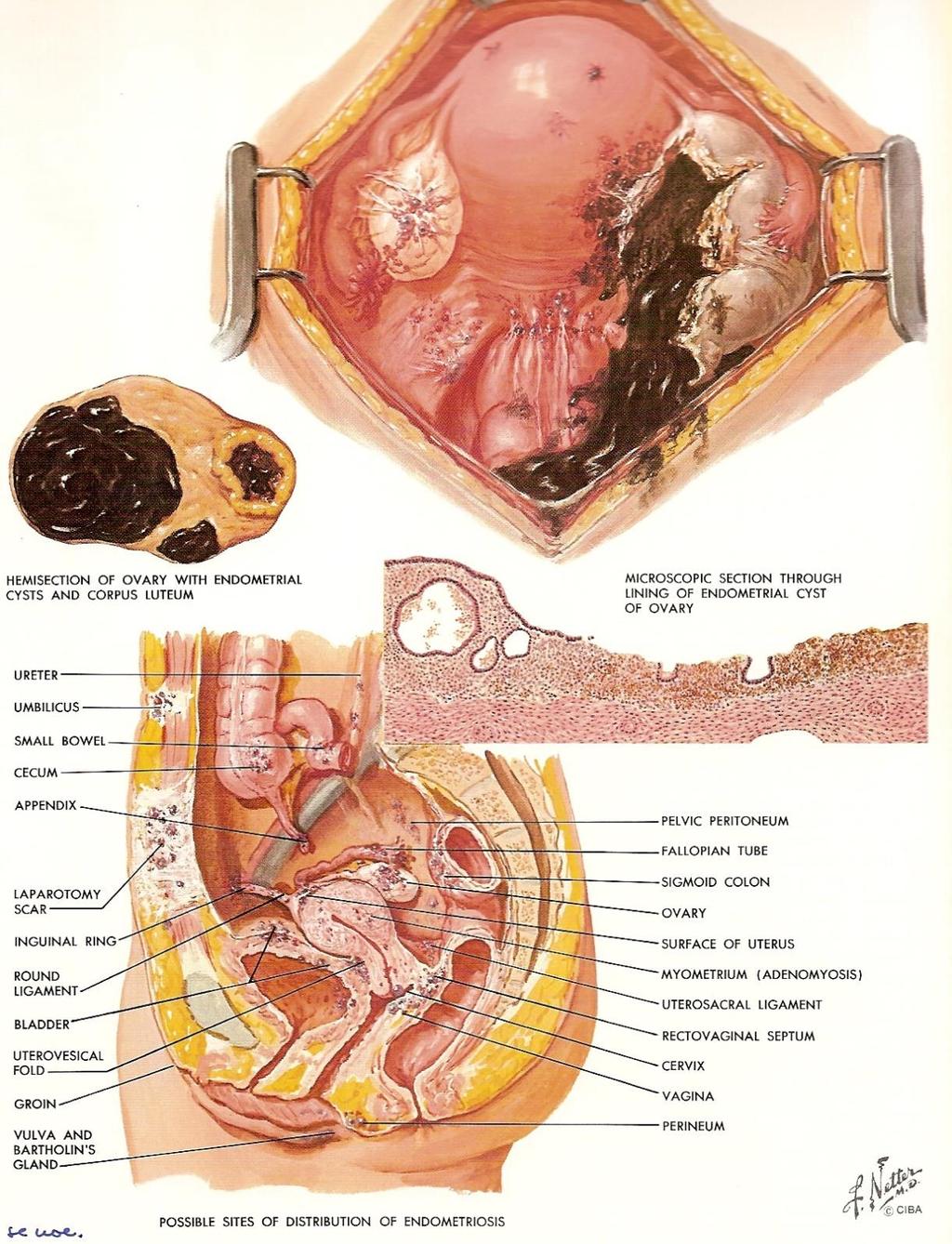 Tumor følger fysiske lover, husk