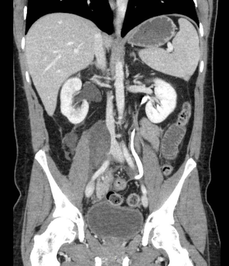 29.sept: reinnlegges grunnet magesmerter, CT: Lymfocele mellom psoas og pancreasvene.