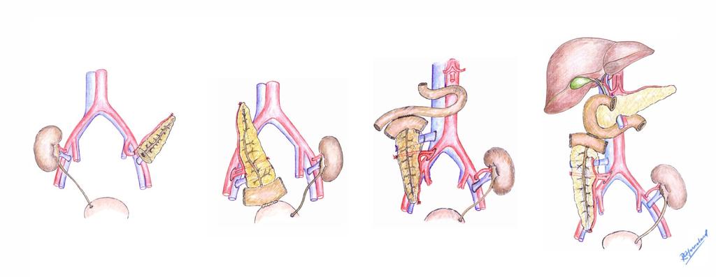 Pancreas-Tx i Norge: Era I: 1983-1988 Era III: