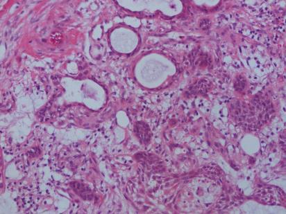 erfaringsmessig sterkt varierende fargekvalitet fra de forskjellige norske labber, til dels substandard kvalitet For adekvat farging se 1: Piaton E m fl 2016: Guidelines for MGG staining