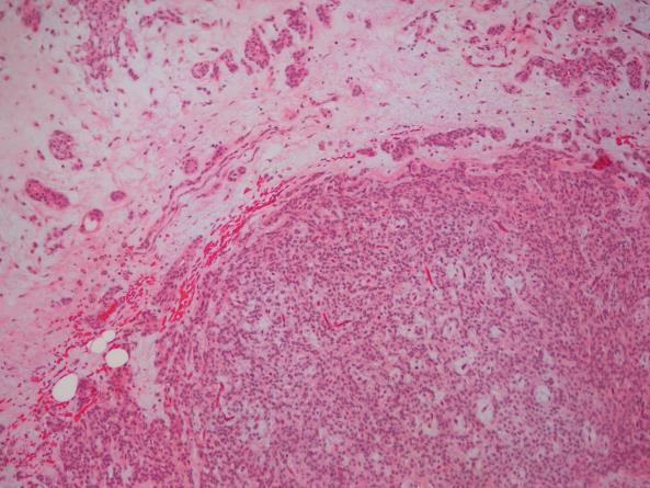 papillary, and cystic structures in a lymphoid stroma.