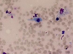 Biopsy Cytology 2008 11 cases 5 Warthin 4 cystic lesions