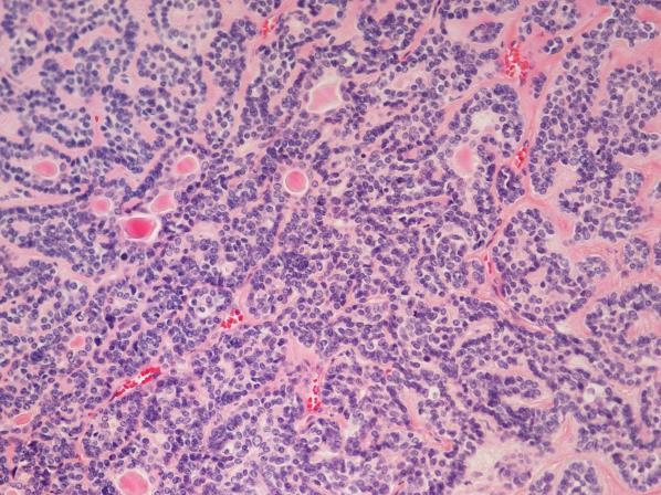 neoplasm composed of small basaloid cells, with occasional inner ductal epithelial cells forming nests