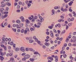 Membranøs subtype kan være multifokal og residivere. p63 Bifasisk immunprofil ck7 WHO 2017.