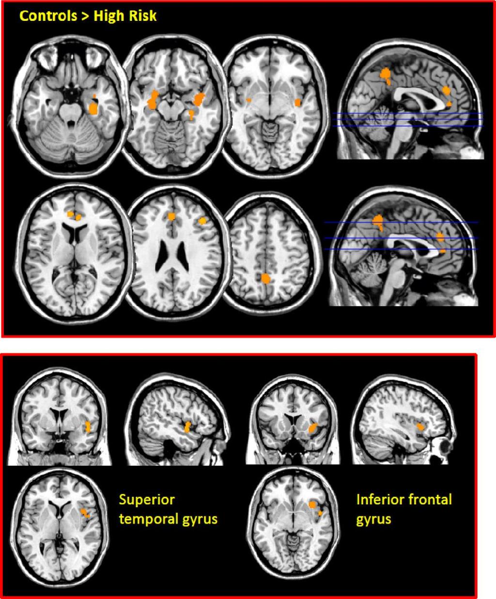 MRI: UHR vs friske- metaanalyse 749 controls, 920 UHR patients Reduced grey