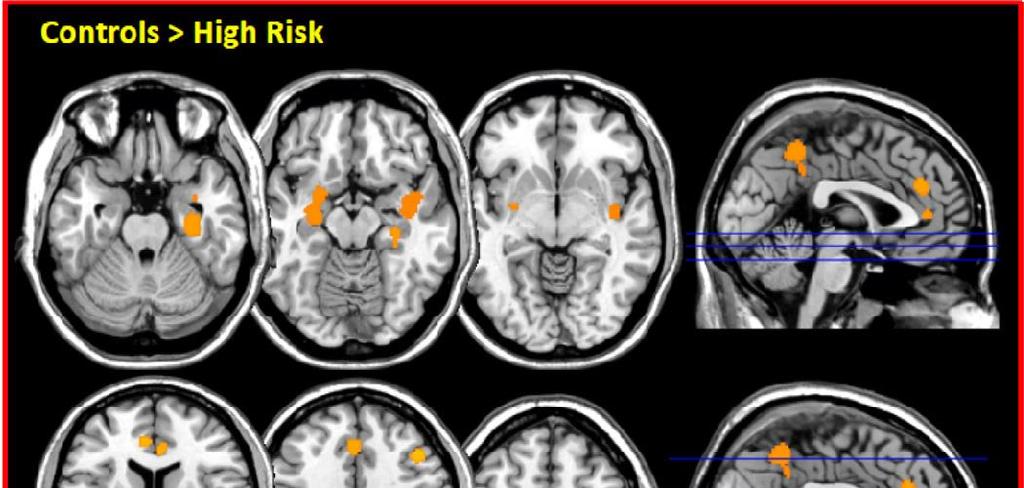 Conversion to psychosis: MRI