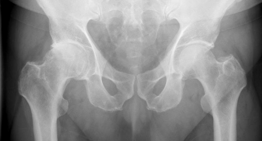 Hofteprotese Hofteproteseoperasjon Sementerte/ usementerte proteser Bakre tilgang til hofteleddet Tar ca 45-75 min. Spinal bedøvelse (evt.