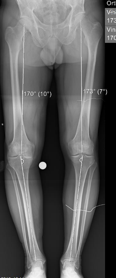 Kneprotese Kneproteseoperasjon «Halv-» og total kneprotese Standardisert tilgang, men avhengig av type protese Tar ca 50-90 min.